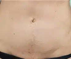 Huidverslapping behandeling voor na Onda