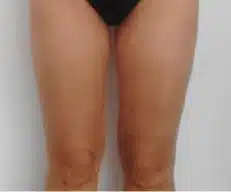 cellulite behandeling voor na Onda