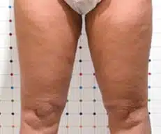 cellulite behandeling voor na Onda