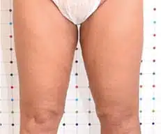 cellulite behandeling voor na Onda