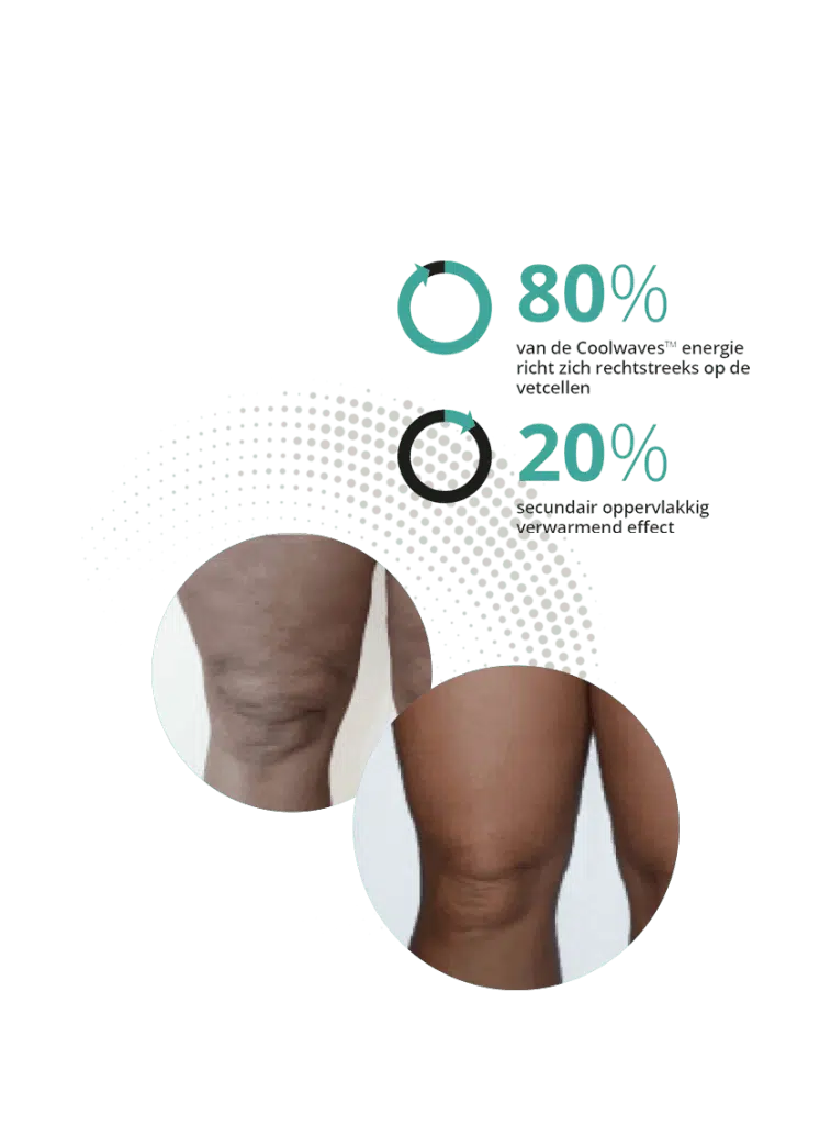 Onda Coolwaves Figuurcorrectie Body contouring Onda Coolwaves Figuurcorrectie Body contouring