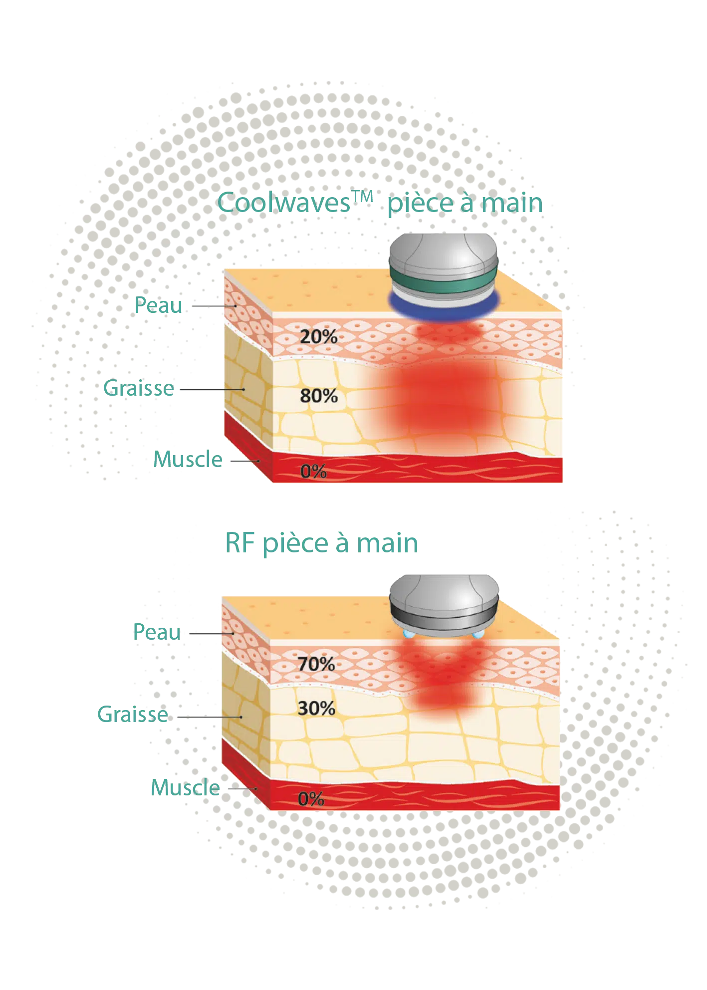 Onda Coolwaves bodyshaping Pièce à main Modelage du corps Onda Coolwaves bodyshaping Pièce à main Modelage du corps